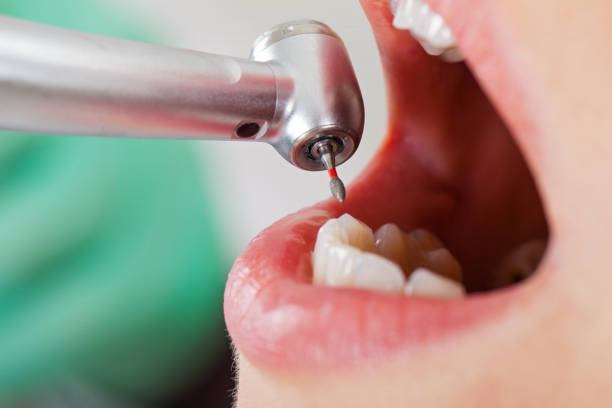 Best Emergency Root Canal Treatment in Port Allen, LA